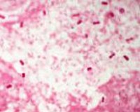 Bacterial Klebsiella pneumoniae outbreak at Mater Dei
