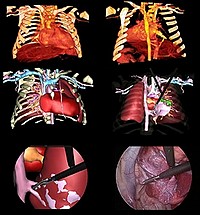 New “virtual liver” technology helps detect liver tumours