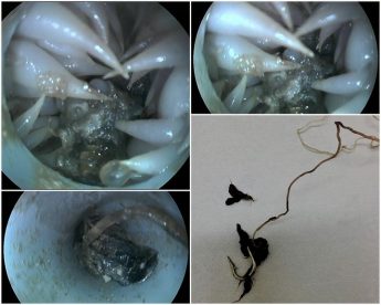 New endoscope procedure used to remove hook from a turtle